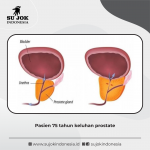 Twist therapy –  Prostate